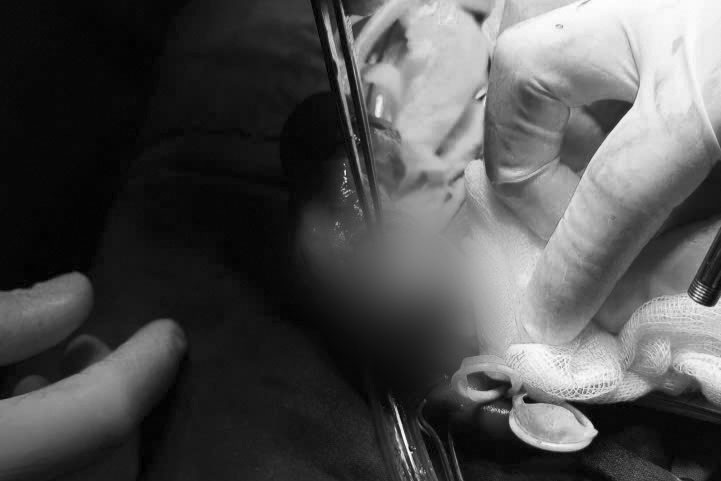 Người đàn ông nhập viện trong tình trạng tai nạn nam khoa nghiêm trọng