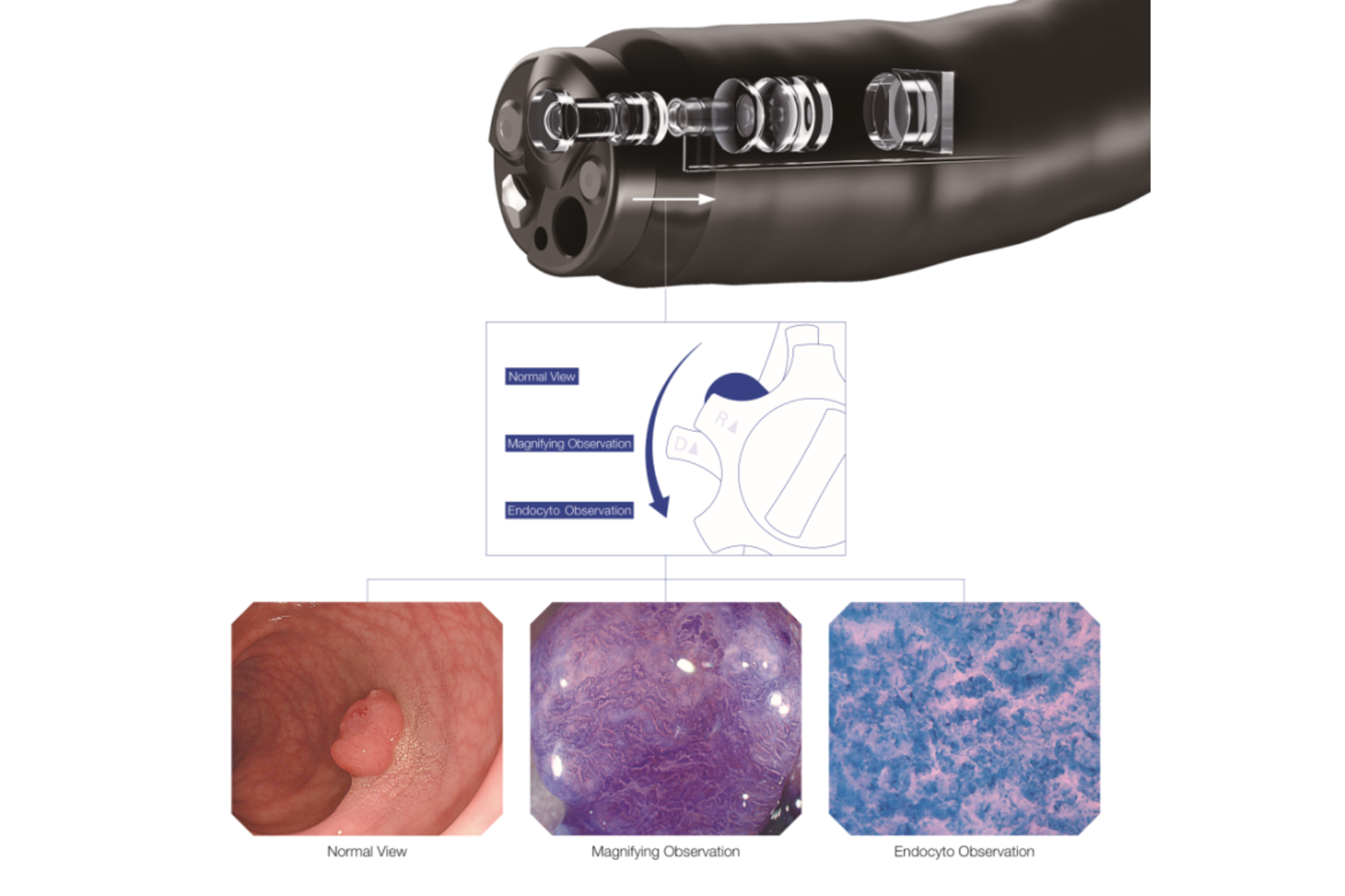 Nội soi tiêu hóa phóng đại 520 lần: Bước tiến trong phát hiện ung thư sớm ở cấp độ tế bào