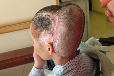 TPHCM: Cô gái đột qụy, biến dạng vùng đầu nặng nề sau phẫu thuật thẩm mỹ