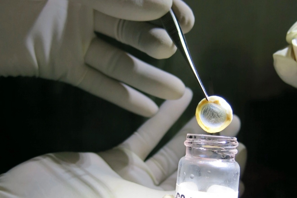 500.000 người bị mù do bệnh lý giác mạc