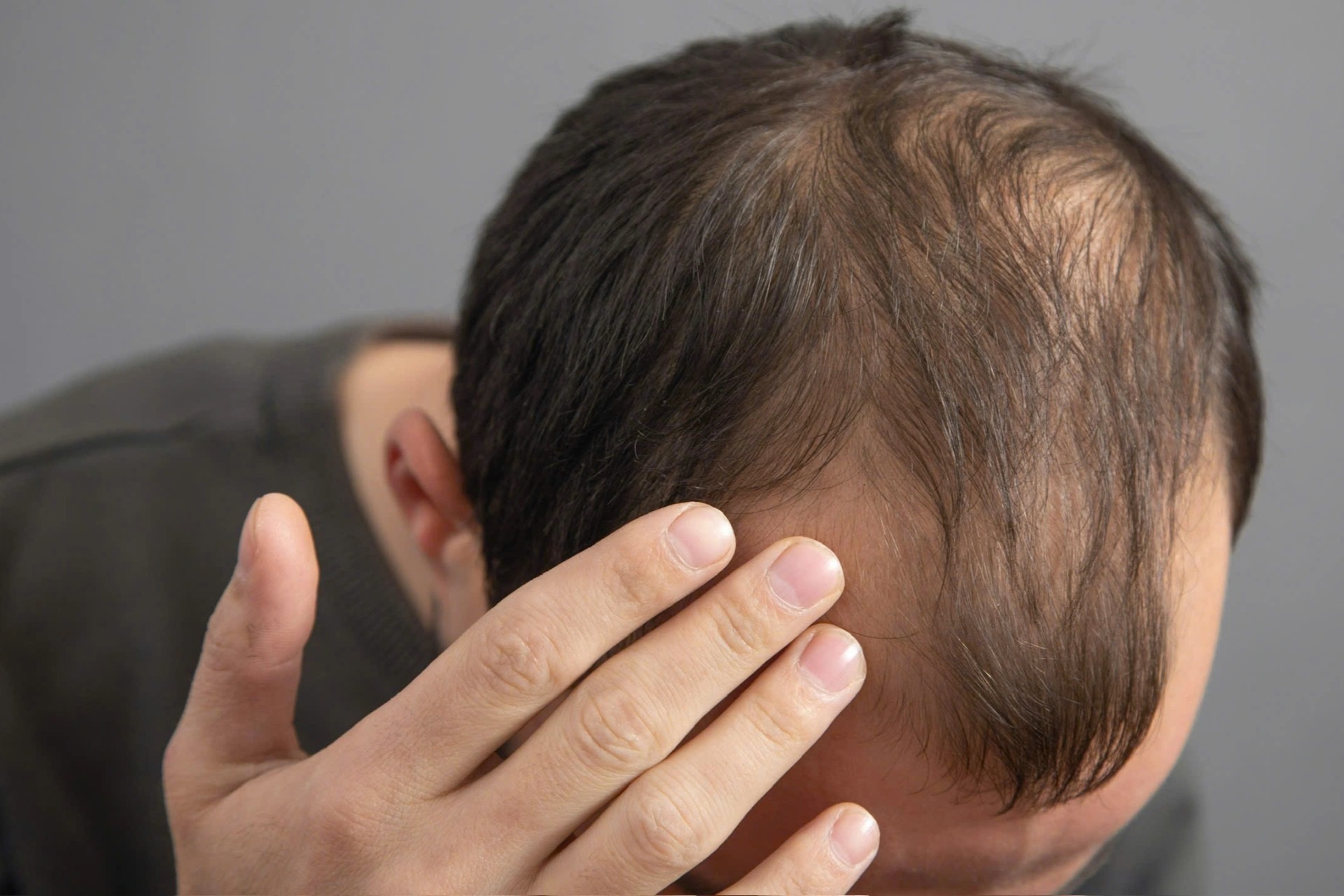 Mỹ thu hồi hàng nghìn chai thuốc chứa hoạt chất quen thuộc trị hói đầu