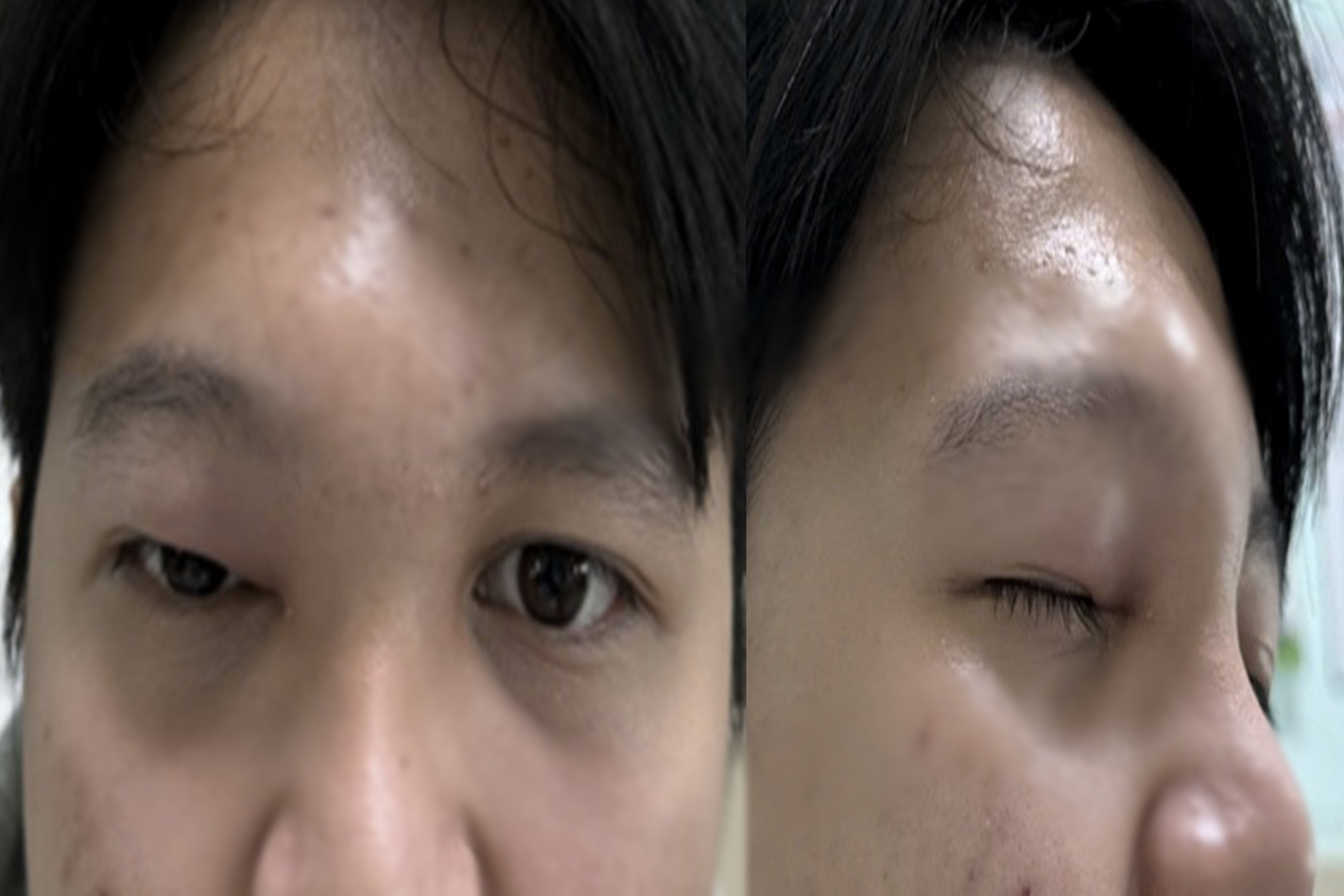 Chàng trai bỗng bị hủy xương vùng mặt, suýt mất mạng sau khi chảy mũi đục