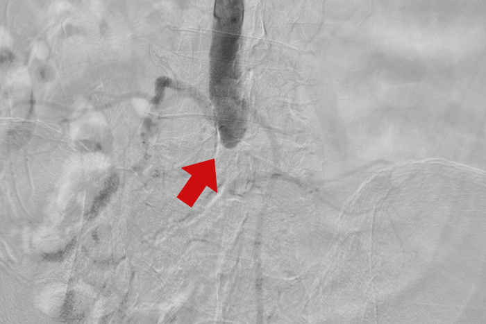 Đau chân 10 năm không khám, người đàn ông suýt mất hai chân vì tắc mạch máu