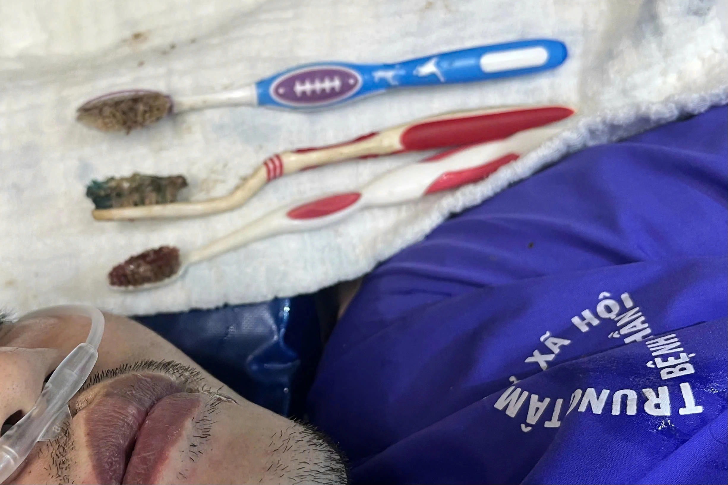 Bác sĩ gắp 3 bàn chải đánh răng từ đường tiêu hóa bệnh nhân