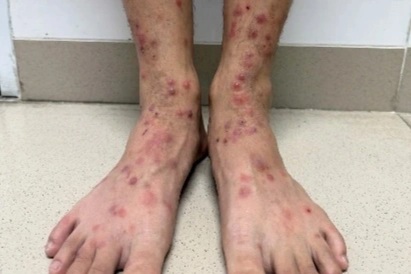 Nhiều người da nổi kín sẩn đỏ, ngứa ngáy vì bọ chét