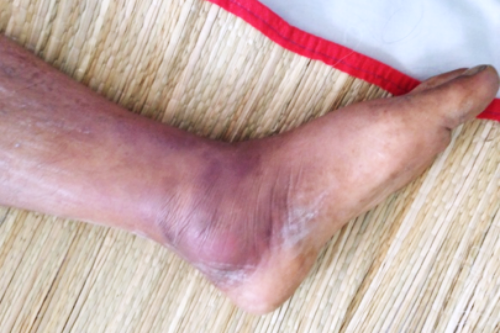 Bệnh "sốt đất" khiến hàng chục người ở Thái Lan tử vong nguy hiểm ra sao?