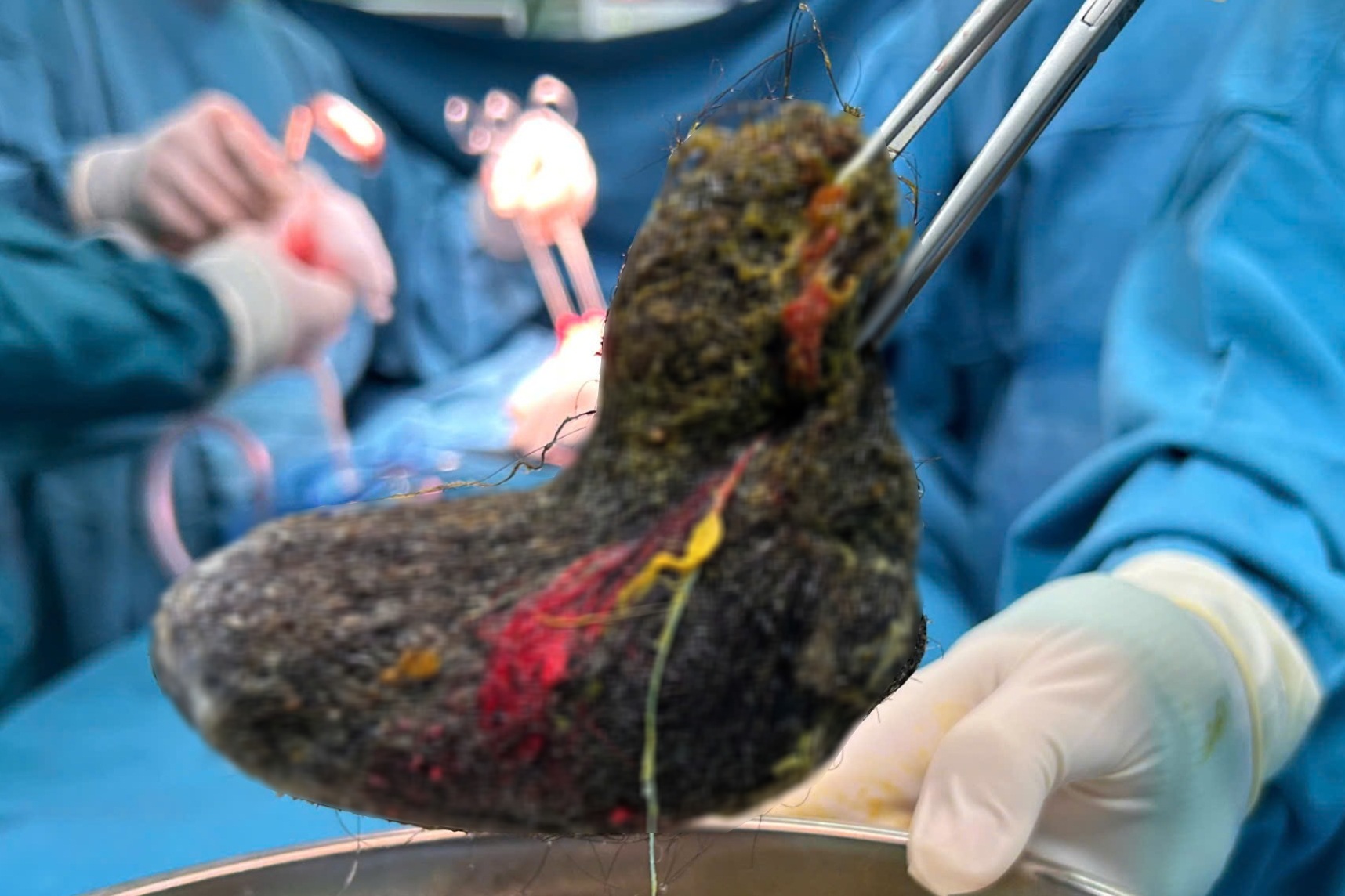 Búi tóc lấp kín dạ dày bé gái 7 tuổi