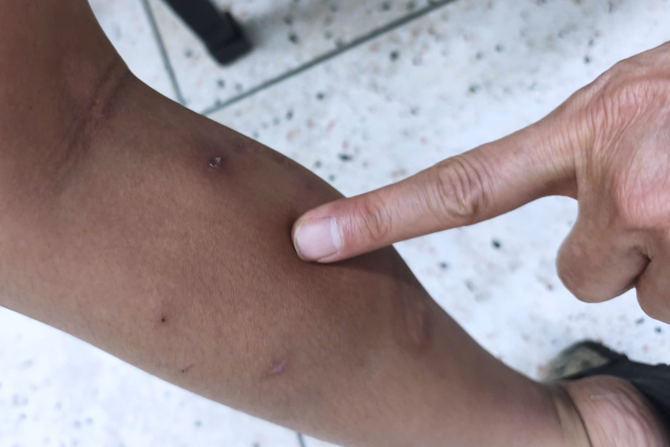 Diễn biến bất ngờ về ca bệnh bé trai sợ nước, kích động sau khi bị chó cắn