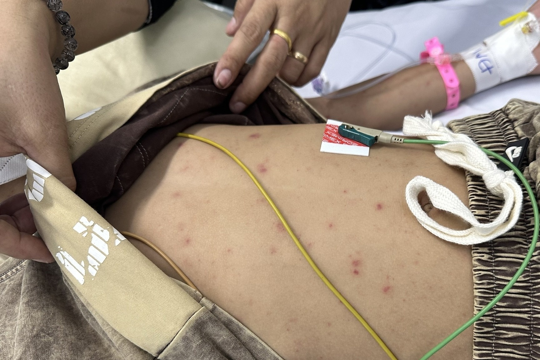 Não mô cầu: Bệnh hiểm tấn công học sinh, phòng ngừa đặc hiệu bằng vaccine