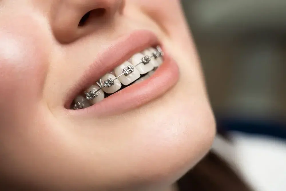 Lý do người hiện đại phải niềng răng