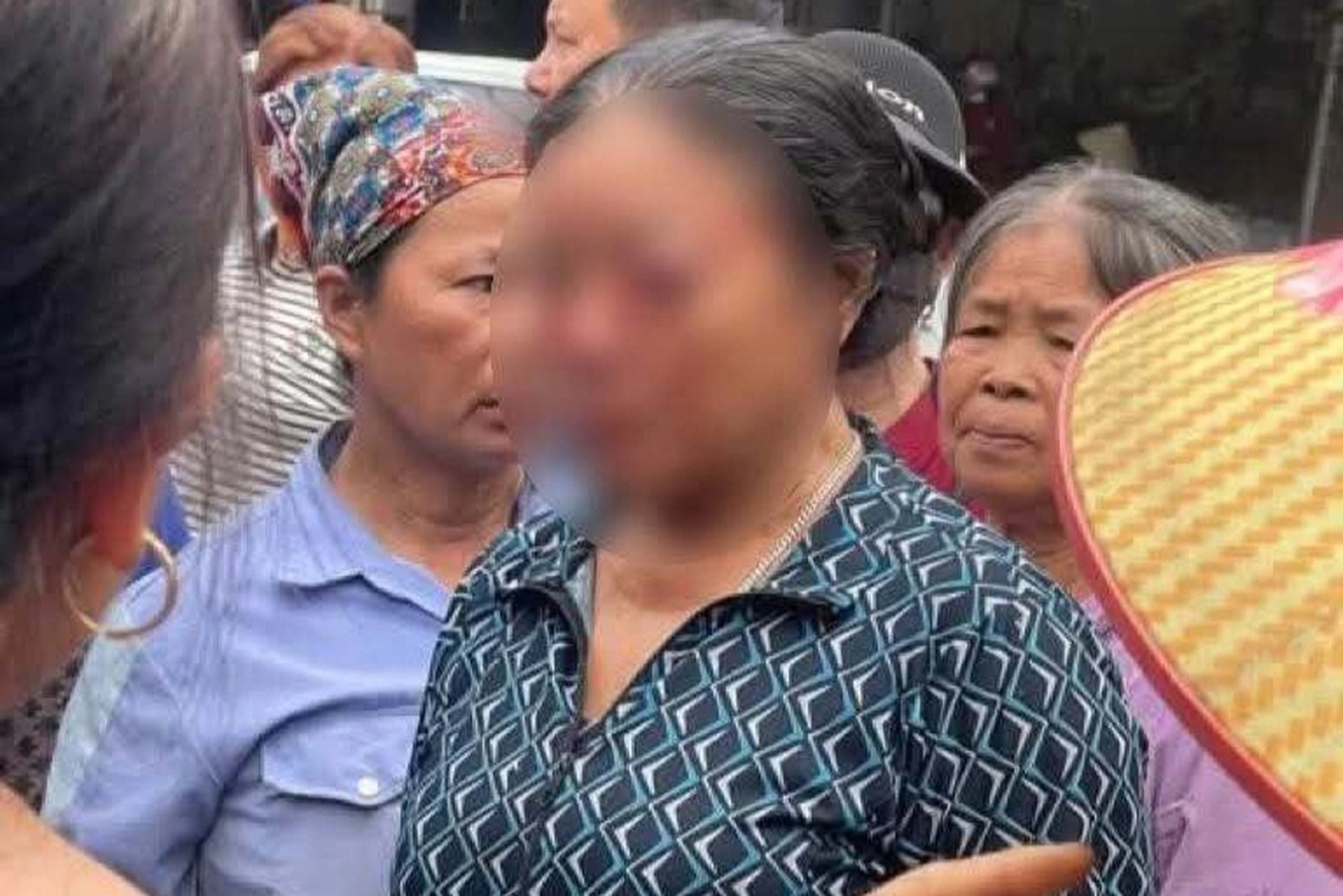Bà bán rau bị xịt vòi nước áp lực cao: Diễn biến sức khỏe mới nhất