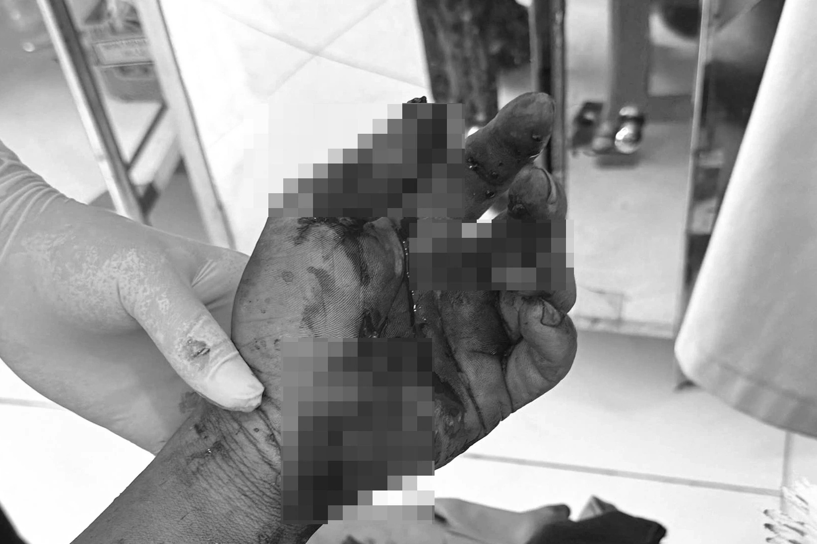 Điện thoại phát nổ khi sạc pin, nam thanh niên ở Lâm Đồng bị dập bàn tay