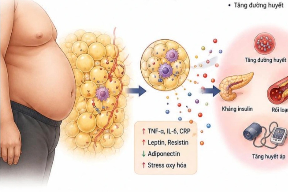 Béo phì tăng "dựng đứng" kéo theo gánh nặng bệnh tim mạch