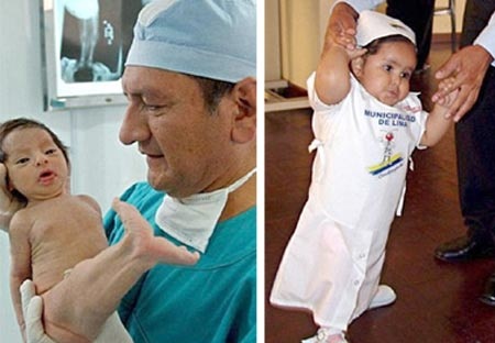 Giải mã hiện tượng nàng tiên cá trong đời thực - 3 Nàng tiên cá bé nhỏ người Peru đã tự đứng và đi
vịn sau ca phẫu tŨuật thứ hai lúc 2 tuổi.