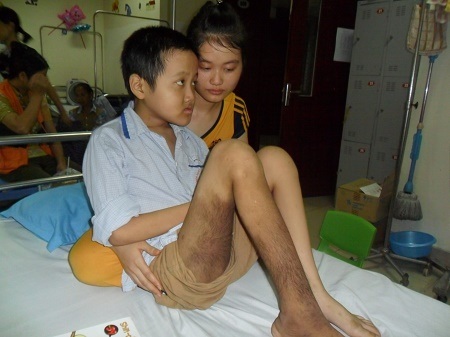 Cả gia đình lao đao vì bố bị u thần kinh, con trai ung thư máu - 2 Chân và đùi của em mọc đầy lông, bản thân em còn mắc bệnh tự kỉ.