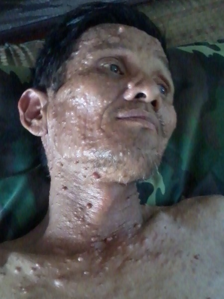 Cả gia đình lao đao vì bố bị u thần kinh, con trai ung thư máu - 5 Bố của Đồng bị u thần kinh nhiều năm nay nhưng không có tiền đi viện chữa trị.