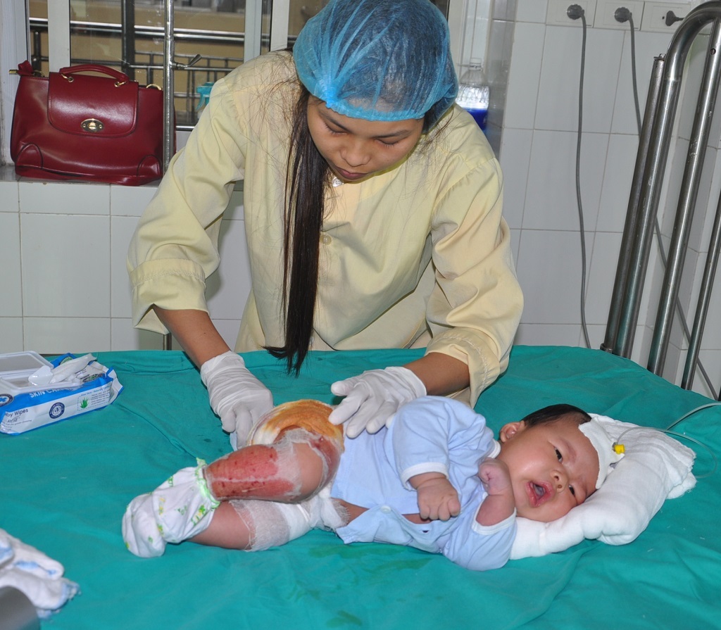 Tai nạn bỏng của con do lỗi của mẹ đã để em nằm một mình.