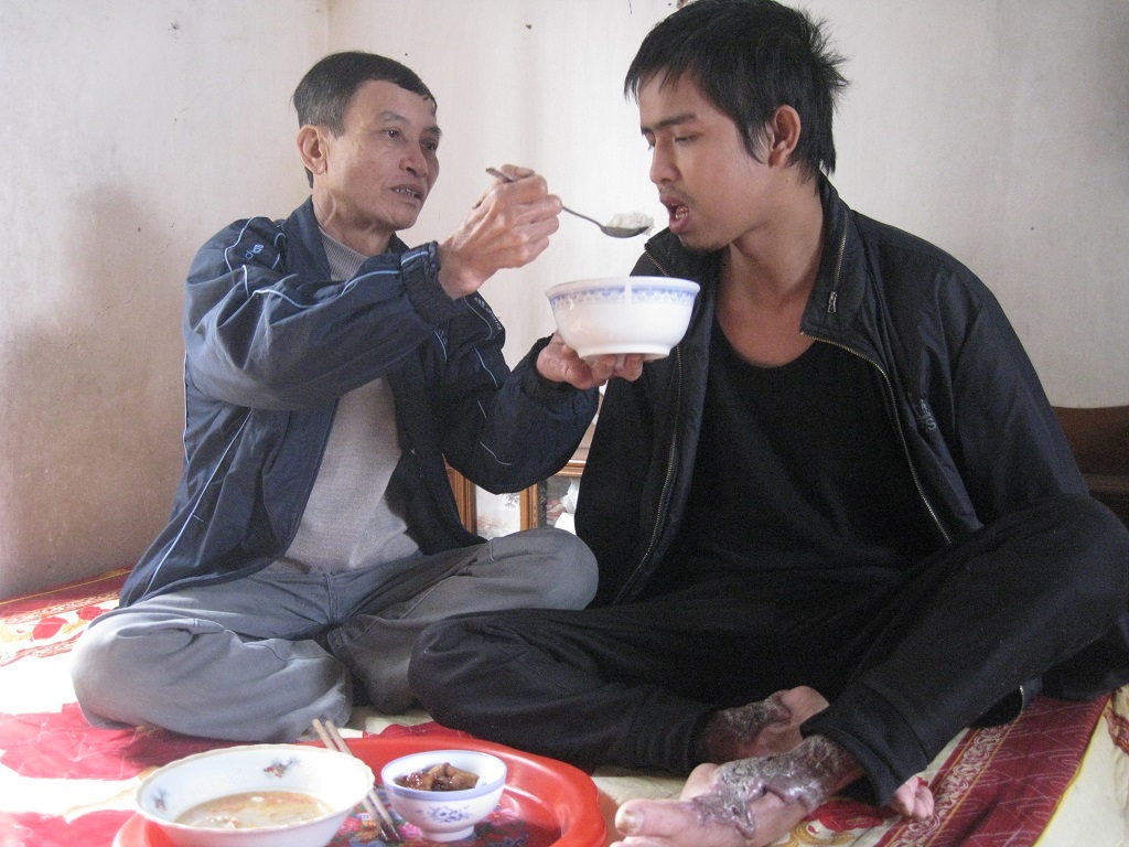 Phải cắt bỏ tay nên hàng ngày bác Thắng phải xúc cơm cho con ăn.