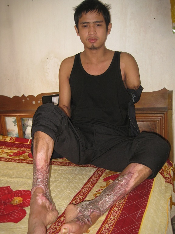 Sau tai nạn bỏng điện cao thế, cơ thể anh Mạnh bị tàn phá ghê gớm.