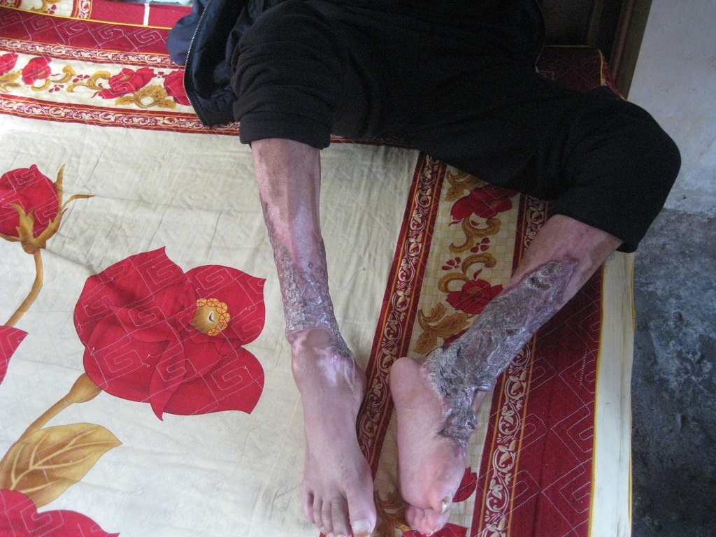 Những khoảng da nhăn nhúm, co kéo khiến anh Mạnh đau đớn.