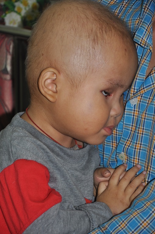 Nam Phong sau hơn 2 tháng điều trị ở viện K, tóc đã rụng đi nhiều.