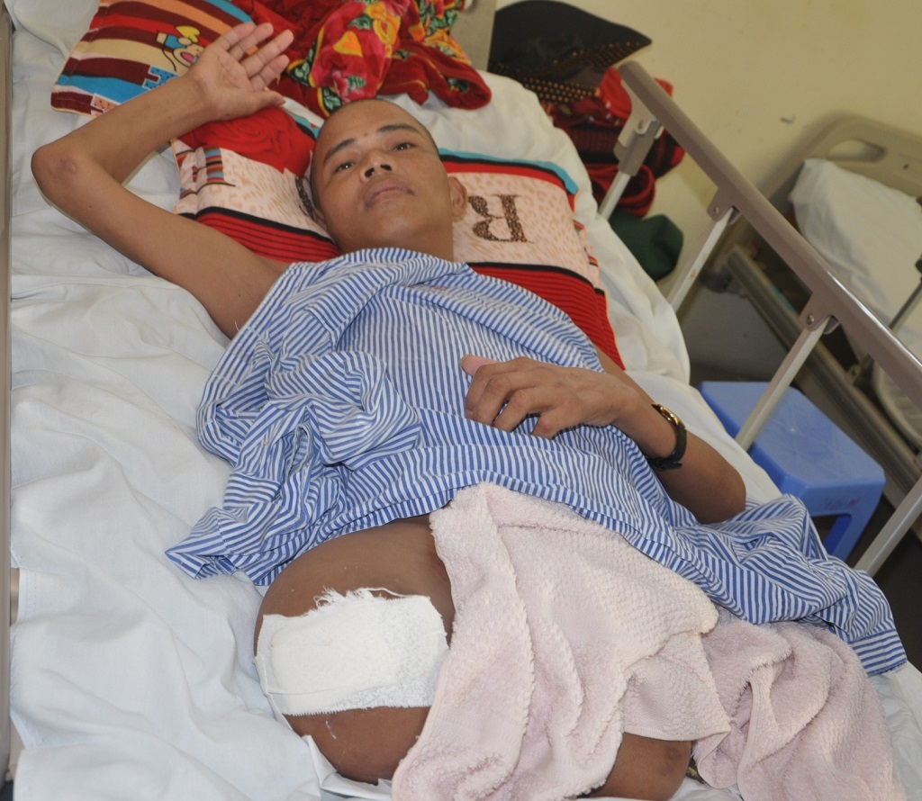 Sau tai nạn ngã từ trên cao xuống, hiện anh Nhã phải tháo hoàn toàn 2 chân.