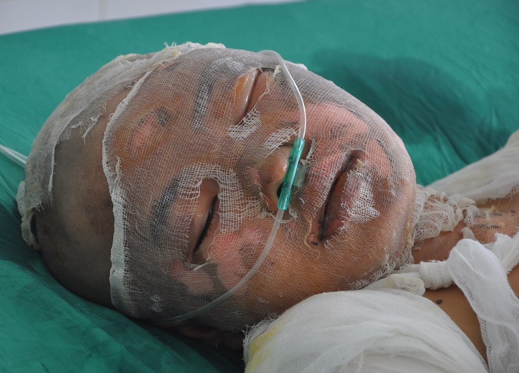 Bé Linh Giang với 50% bỏng, 13% bỏng sâu độ 3,4 ở mặt, thân, chi.