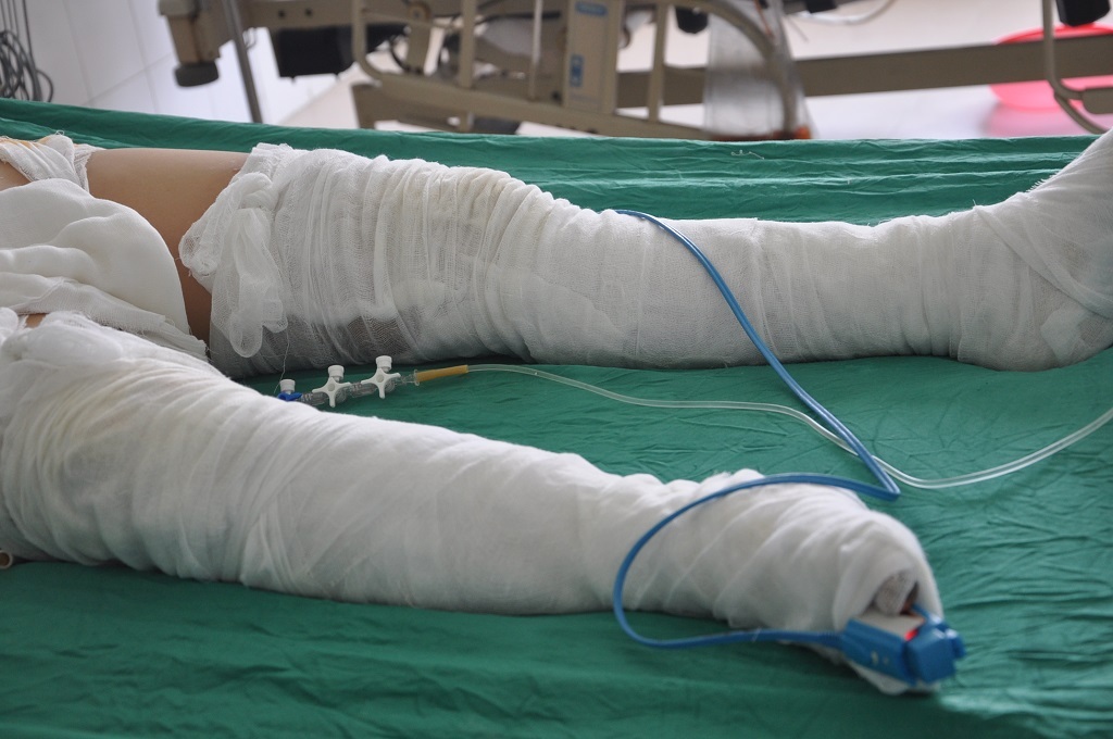 ...Đến chân đều bị bỏng nặng.