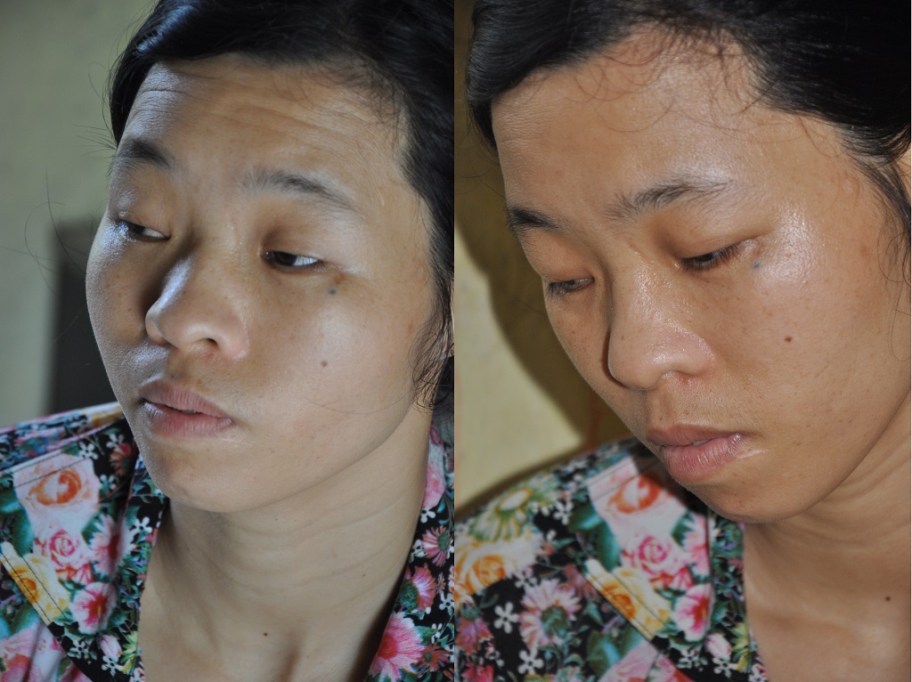 Ngoài ra em còn bị thoát vị bẹn khiến bộ phận sinh dục sưng tấy gây đau đớn.