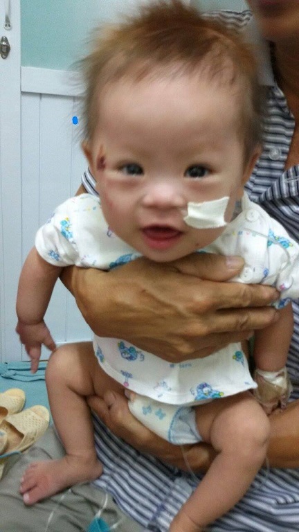 Nụ cười dễ thương của cô bé Lộc sau ca mổ tim thành công.