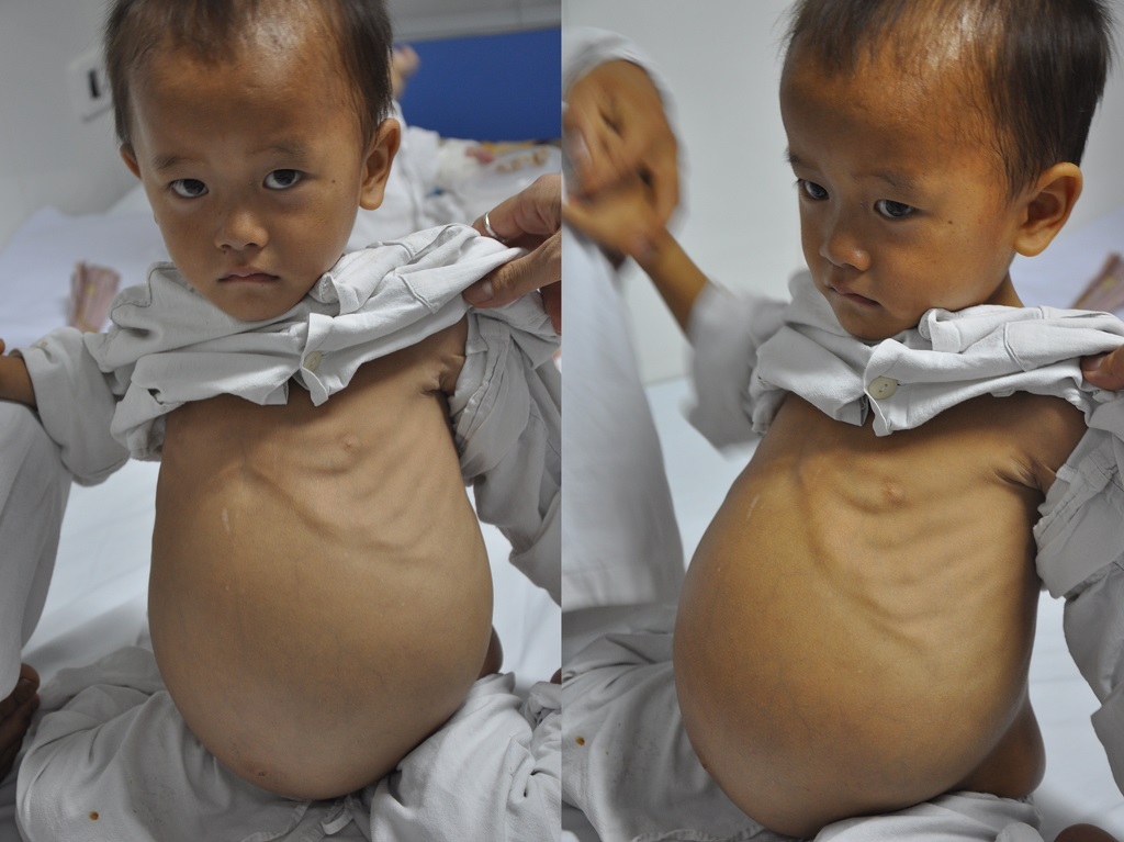 Bị u thận khiến bụng của bé Trông phình to như cái trống.