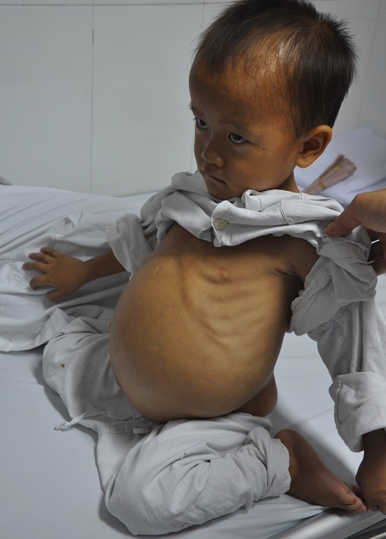 Phát hiện bụng con to lên cách đây 1 năm...