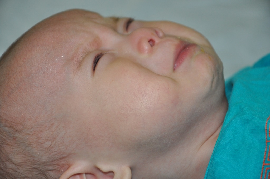 Bị tim bẩm sinh thông liên thất, thông liên nhĩ, hở van 3 lá, tăng áp phổi nặng.