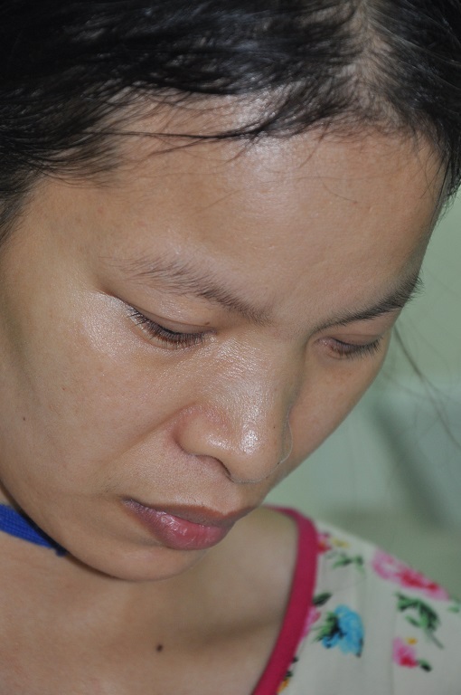 Đi chăm con nhưng đôi mắt của chị không nhìn rõ nữa bởi viêm giác mạc nặng.