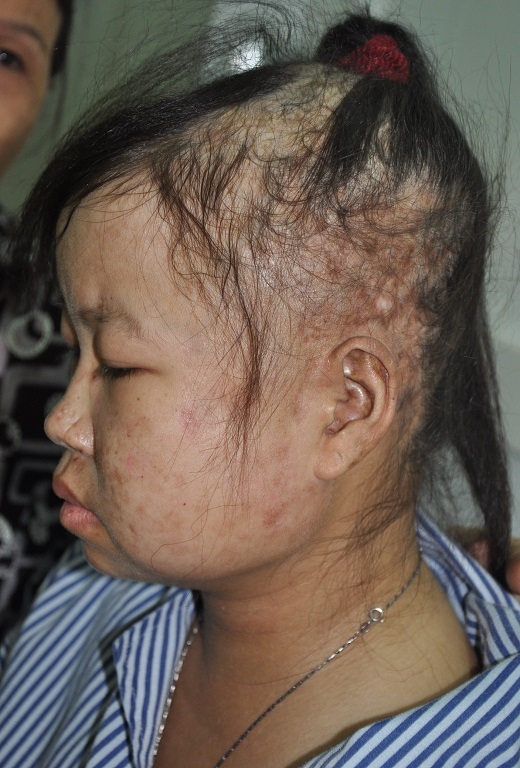 Căn bệnh đang ở giai đoạn nguy hiểm khi tàn phá cơ thể của em ghê gớm.