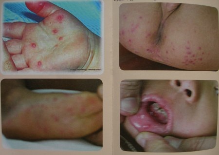 Bệnh tay chân miệng tăng mạnh đầu năm - 1