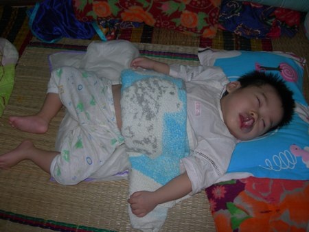 Bé 18 tháng tuổi bị u máu, bại não, mù bẩm sinh