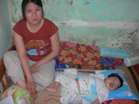 Bé 18 tháng tuổi bị u máu, bại não, mù bẩm sinh