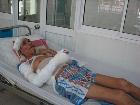 Vào rừng đốt rẫy, bị bỏng nặng