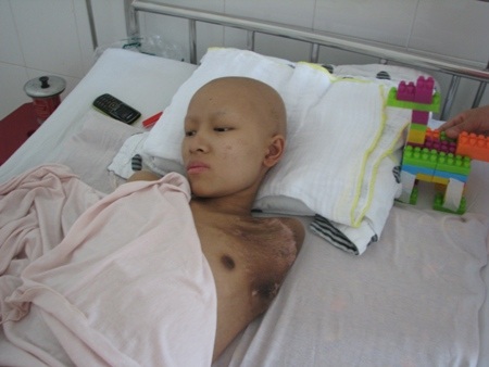 Bệnh ung thư mô mềm khiến Hồng Vy phải tháo cả cánh tay trái