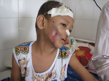 Má phải của cháu đã bị hoại tử do nhiễm trùng