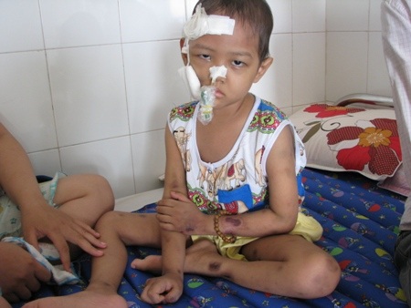 Má phải của cháu đã bị hoại tử do nhiễm trùng