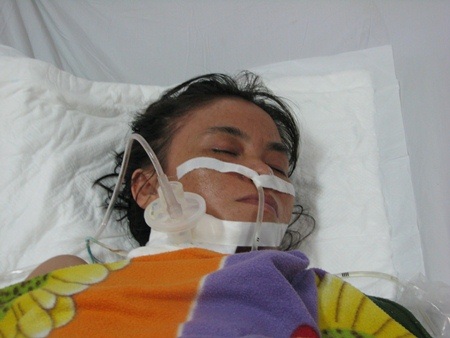 Chị Nở bị đa chấn thương, trong tình trạng di chứng não