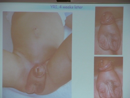 Một bộ phận sinh dục sau khi được phẫu thuật tái tạo