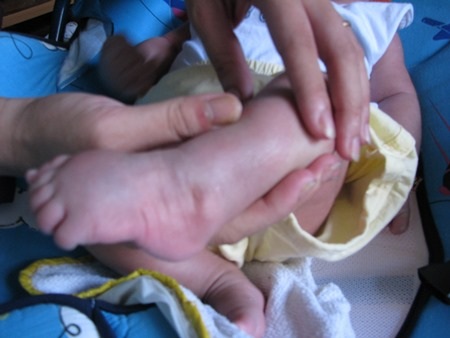 Cháu bị khoèo chân lúc ɭới sinh ra