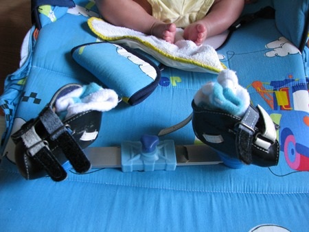 Cứ 2 tuầnȬ các bác sĩ lại đóng cho cháu đôi dép khác để nắn chân