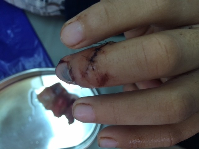 Ngón tay bị đứt lìa sau khi được nối thành công