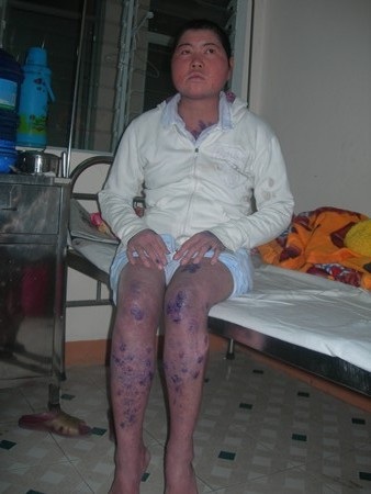 Gia cảnh túng quẫn của cô gái mang bệnh Pemphigus - 1