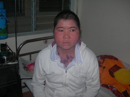 Gia cảnh túng quẫn của cô gái mang bệnh Pemphigus - 2