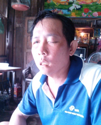 Khốn khổ vì nhổ răng bị mù mắt - 1 Ông Côn cho rằng bác sĩ không xét nghiệm kỹ nên nhổ răng bị mù mắt